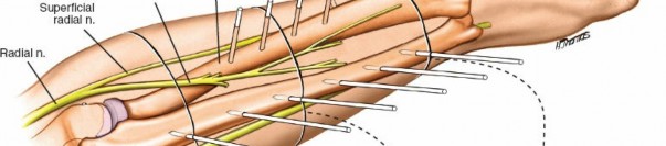 Illustration 2 for Expert Guide: Ulna and Wrist External Fixation Pin Placement