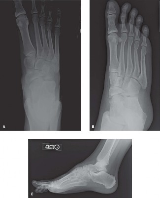 Navicular Fractures: Comprehensive Guide to Etiology, Anatomy, Biomechanics & Diagnosis