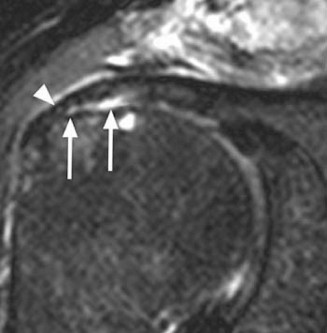 Acute Rotator Cuff Tears: What's Your Diagnosis?