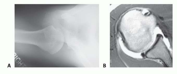 Illustration of treatment of posterior shoulder - Dr. Mohammed Hutaif