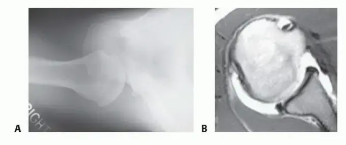 صورة توضيحية لـ عدم استقرار الكتف الخلفي: دليل شامل للعلاج بالمنظار والتعافي الكامل