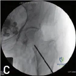 صورة توضيحية لـ الأكياس العظمية وحيدة الحجرة وكسور الإجهاد الفخذية: دليل شامل للمرضى في اليمن مع الأستاذ الدكتور محمد هطيف