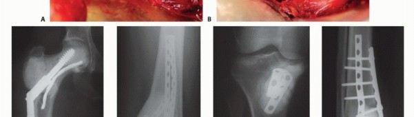 صورة طبية: تجنب الجراحة الكبرى: علاج أورام العظام بالنيتروجين السائل بتقنية الصب المباشر