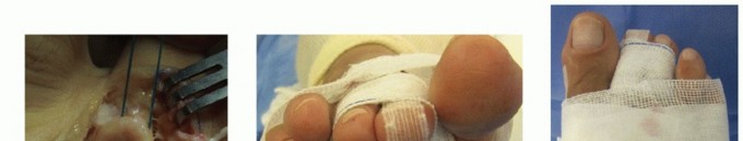 Illustration 30 for Plantar Plate Repair: End Lesser Toe Pain & Instability