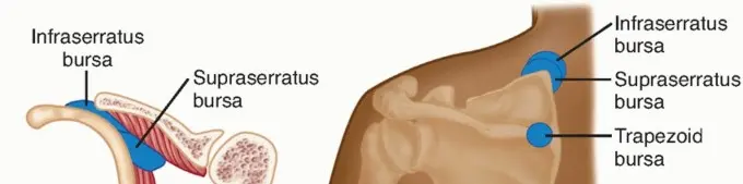 صورة توضيحية لـ متلازمة لوح الكتف الطقطقة الأسباب الأعراض والعلاج مع الأستاذ الدكتور محمد هطيف