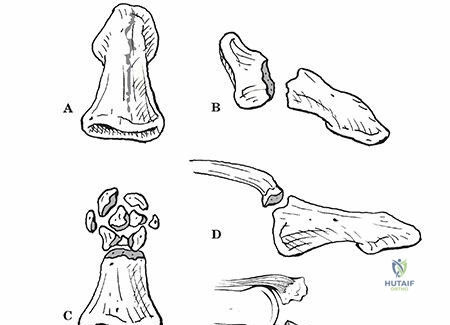 Illustration of crif versus orif - Dr. Mohammed Hutaif