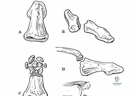 Illustration of crif versus orif - Dr. Mohammed Hutaif