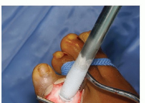 صورة طبية: تجنب الجراحة الكبرى: علاج أورام العظام بالنيتروجين السائل بتقنية الصب المباشر