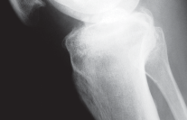Illustration 5 for Unicompartmental Knee Arthroplasty: Master decisions with this b c figure guide.