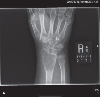 Illustration of giant cell tumor - Dr. Mohammed Hutaif