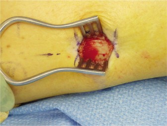 Foot Ulcer Diagnosis: Is It Isolated Gastrocnemius Contracture?