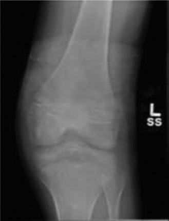 Tibial Eminence Fracture: Case 36 Diagnosis & Surgical Insights