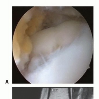 Beyond Microfracture: ACT for Stubborn Osteochondral Lesions