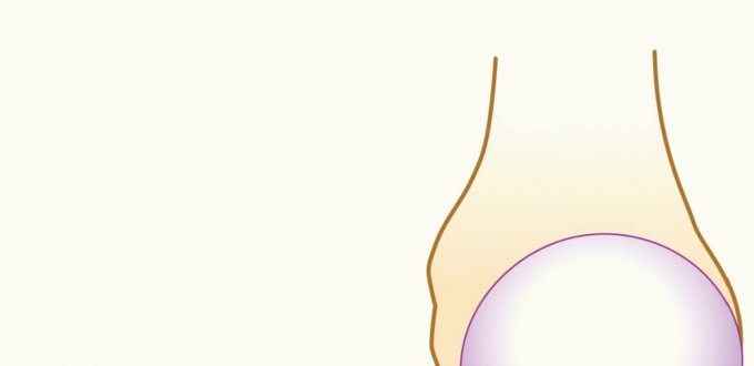 Illustration of burkhart ss lo ik - Dr. Mohammed Hutaif