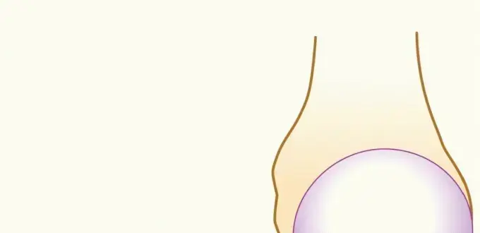 صورة توضيحية لـ جراحة لاتاريت: حل نهائي لعدم استقرار الكتف الناتج عن فقدان العظم – مع الأستاذ الدكتور محمد هطيف