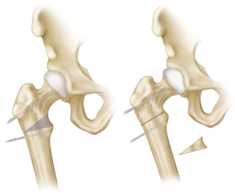Illustration 9 for Intertrochanteric Femoral Osteotomy: Indications for Hip Preservation