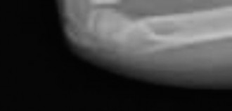 Illustration 4 for Pediatric Orthopedic Cases: Diagnose & Treat a Child's Wrist Fracture