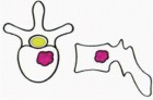 Illustration 5 for Total En Bloc Spondylectomy: Complete Resection for Spinal Tumors