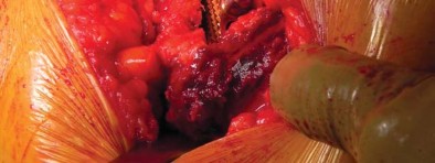 صورة طبية: تقنية الجذع القصير لاستبدال مفصل الورك الكلي: نهج الأستاذ الدكتور محمد هطيف لتدخل جراحي أقل ونتائج أفضل