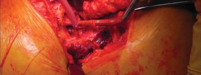 صورة طبية: تقنية الجذع القصير لاستبدال مفصل الورك الكلي: نهج الأستاذ الدكتور محمد هطيف لتدخل جراحي أقل ونتائج أفضل