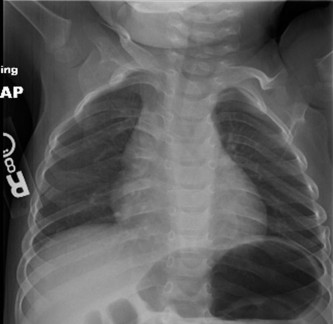 Recognizing Duchenne: Early Signs in Patients with DMD