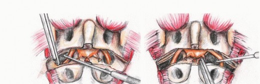 صورة طبية: جراحة أورام العجز: الحفاظ على وظائف الأمعاء والمثانة مع الأستاذ الدكتور محمد هطيف في صنعاء