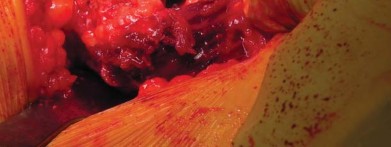 صورة طبية: تقنية الجذع القصير لاستبدال مفصل الورك الكلي: نهج الأستاذ الدكتور محمد هطيف لتدخل جراحي أقل ونتائج أفضل