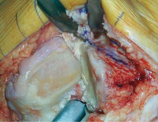 Illustration 22 for Knee Arthroplasty: Avoiding Pitfalls & Benefiting from UKA