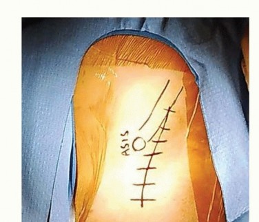 Illustration 12 for Restore Hip Health: Pelvic Osteotomy for Acetabular Dysplasia & CEA of Less