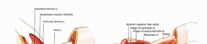 صورة طبية: استئصال نصف الحوض بالرفرفة الأمامية: حلول متقدمة لأورام الحوض الصعبة مع الأستاذ الدكتور محمد هطيف في صنعاء