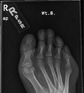 Illustration 2 for Pes Cavus & Ankle Pain: When to Use Coleman Block Testing