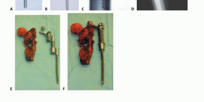 Illustration 2 for Beyond Amputation: Total Femur Resection with Endoprosthetics
