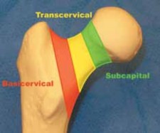 Illustration of reduction and percutaneous fixation - Dr. Mohammed Hutaif