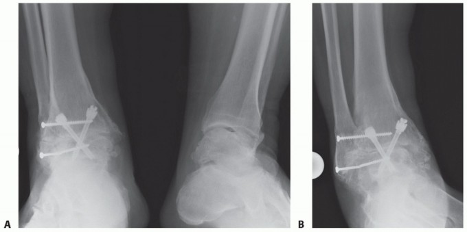 Ankle & Subtalar Joint Fusion: Relieve Pain with Intramedullary Nail