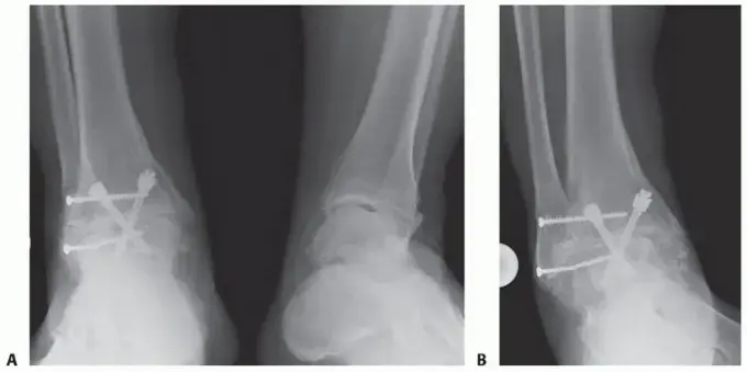 صورة توضيحية لـ دمج مفصل الكاحل والقدم (تثبيت الكاحل تحت الكاحلي): حل نهائي لآلام القدم المزمنة واستعادة الحركة