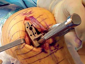 Illustration 59 for Knee Arthroplasty: Avoiding Pitfalls & Benefiting from UKA