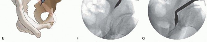 Illustration 22 for Restore Hip Health: Pelvic Osteotomy for Acetabular Dysplasia & CEA of Less