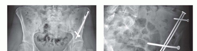 Illustration 25 for Restore Hip Health: Pelvic Osteotomy for Acetabular Dysplasia & CEA of Less