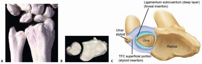Illustration of distal ulna resection - Dr. Mohammed Hutaif