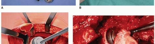 Illustration 13 for Hip Arthrodesis: The Definitive Hip Solution for Active Young Adults