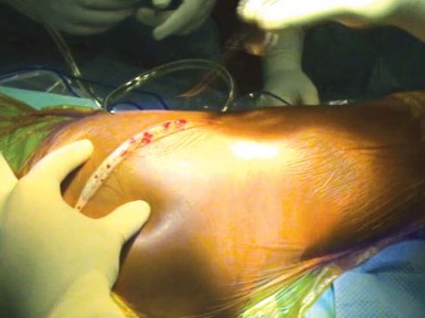 Illustration 7 for Unlock Movement: Arthroplasty for Bony Ankylosis Solutions