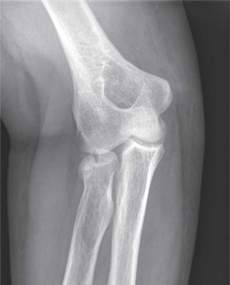 Illustration of radial head fracture - Dr. Mohammed Hutaif