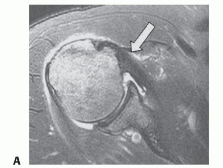 Subscapularis Tendon Tears: Advanced Repair & Biceps Solutions
