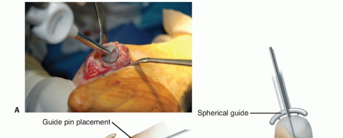 Illustration 16 for End Articular Cartilage Loss: Arthrosurface HemiCAP Resurfacing