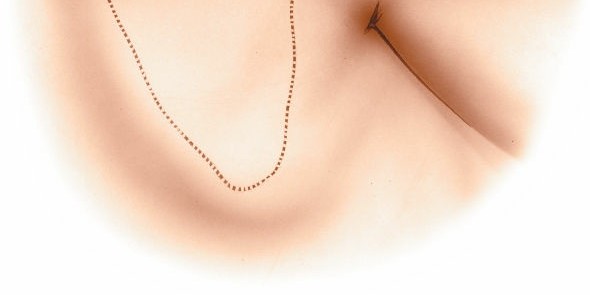 Illustration 160 for Essential Guide: Mastering Every Approach to the Shoulder