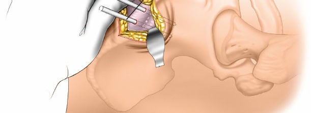 Illustration 19 for Expert Guide: Ulna and Wrist External Fixation Pin Placement