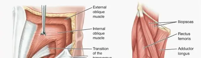 صورة توضيحية لـ ألم الفخذ الرياضي وإصابات العضلة الضامة: دليل شامل للمرضى مع الأستاذ الدكتور محمد هطيف