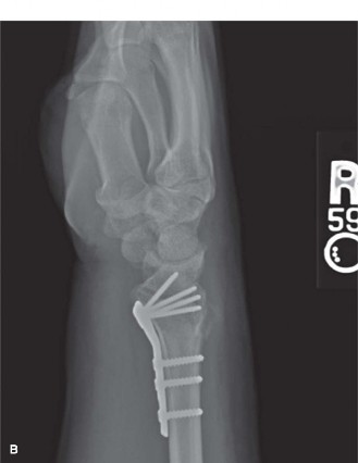 Illustration 3 for Case Distal Radius: Uncover Why Traction Fails Volar Tilt