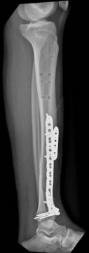 Illustration 17 for Complex Tibial Shaft Fracture: Plate Fixation for Plafond Extension