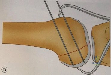 Arab Ortho Board MCQs - Part 13